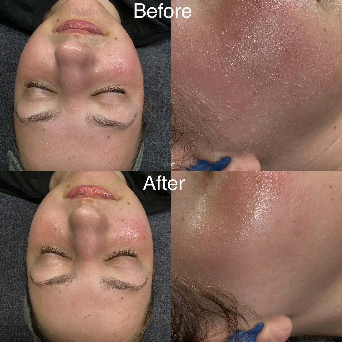 Dermaplaning Facial at Royal Glow Beauty & Esthetics in Boardman, Ohio - 20% off for new clients