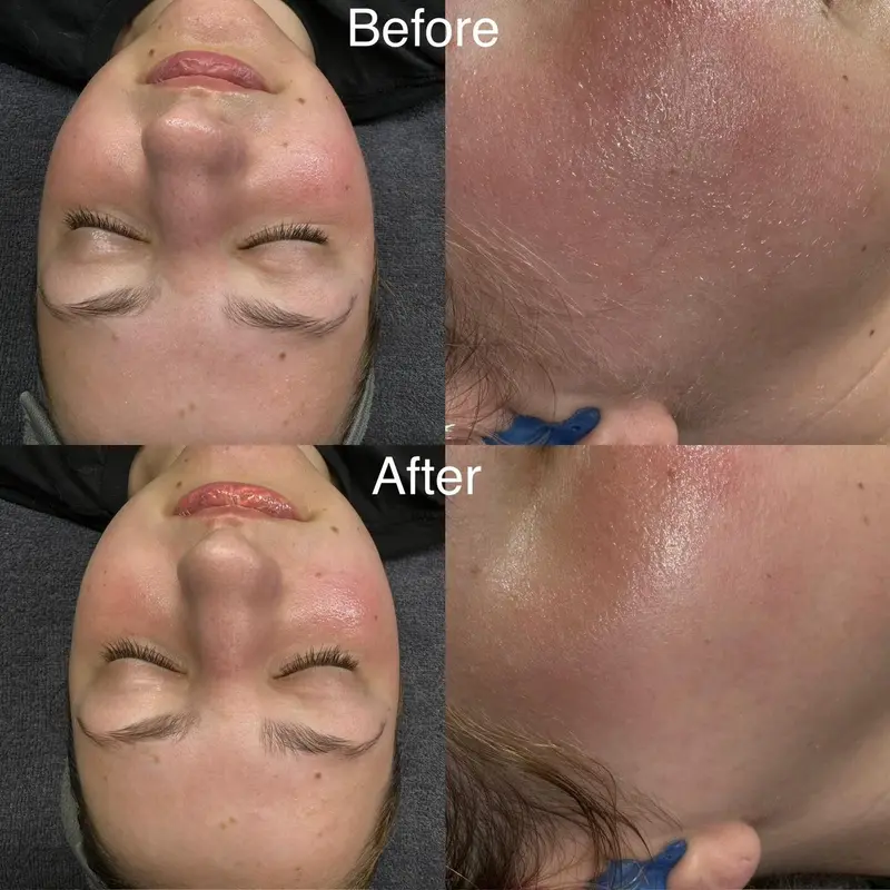 Dermaplaning facial treatment at Royal Glow Beauty & Esthetics in Boardman, Ohio